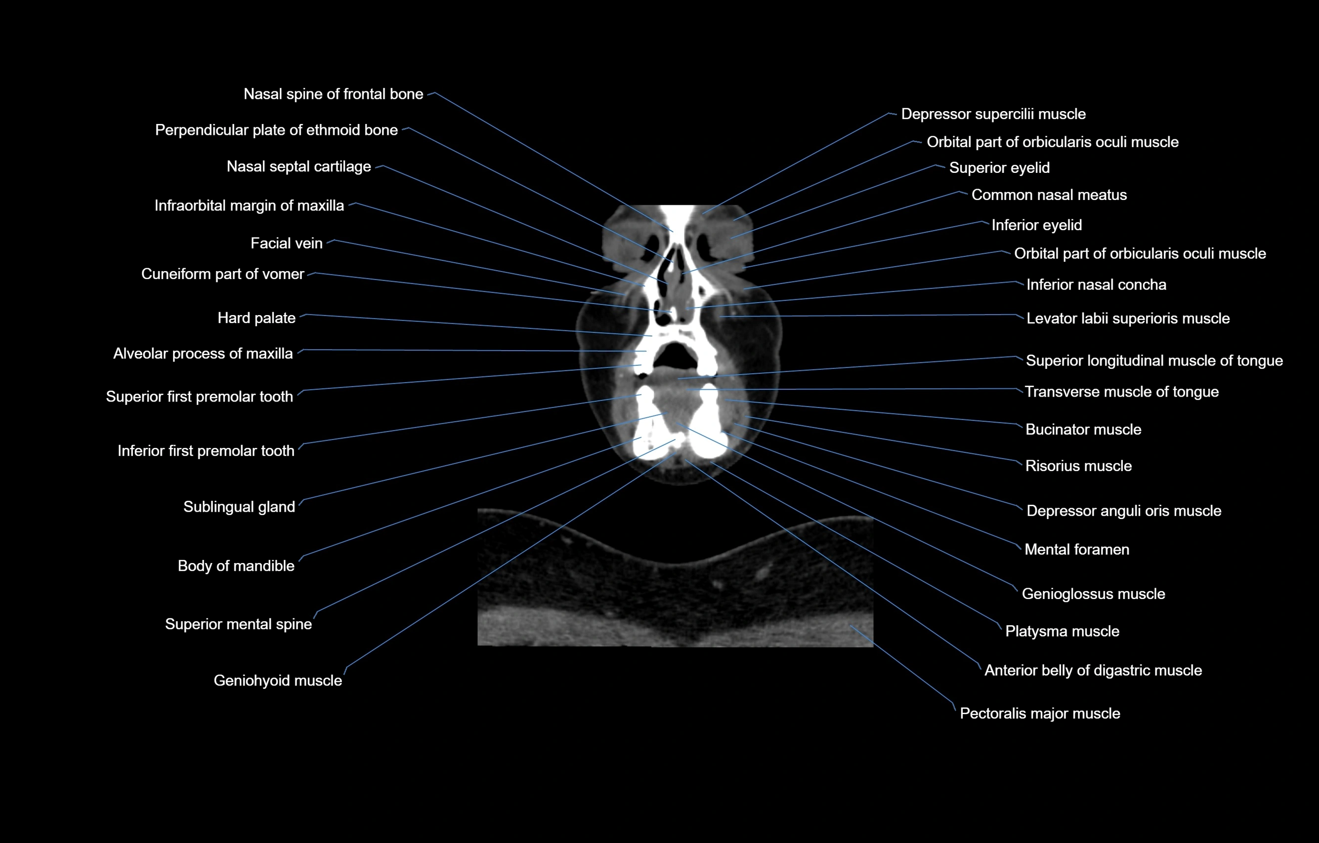 CT Neck coronal  cross sectional anatomy labelled 3D  radiology  image-00011.webp